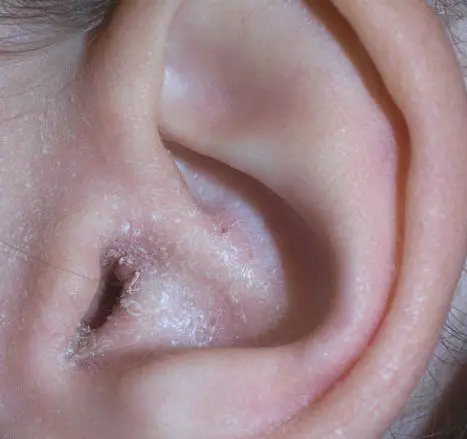 Why do people get ear infections