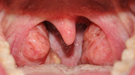 Why Do We Have Tonsils
