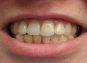 Why Do Teeth Turn Yellow